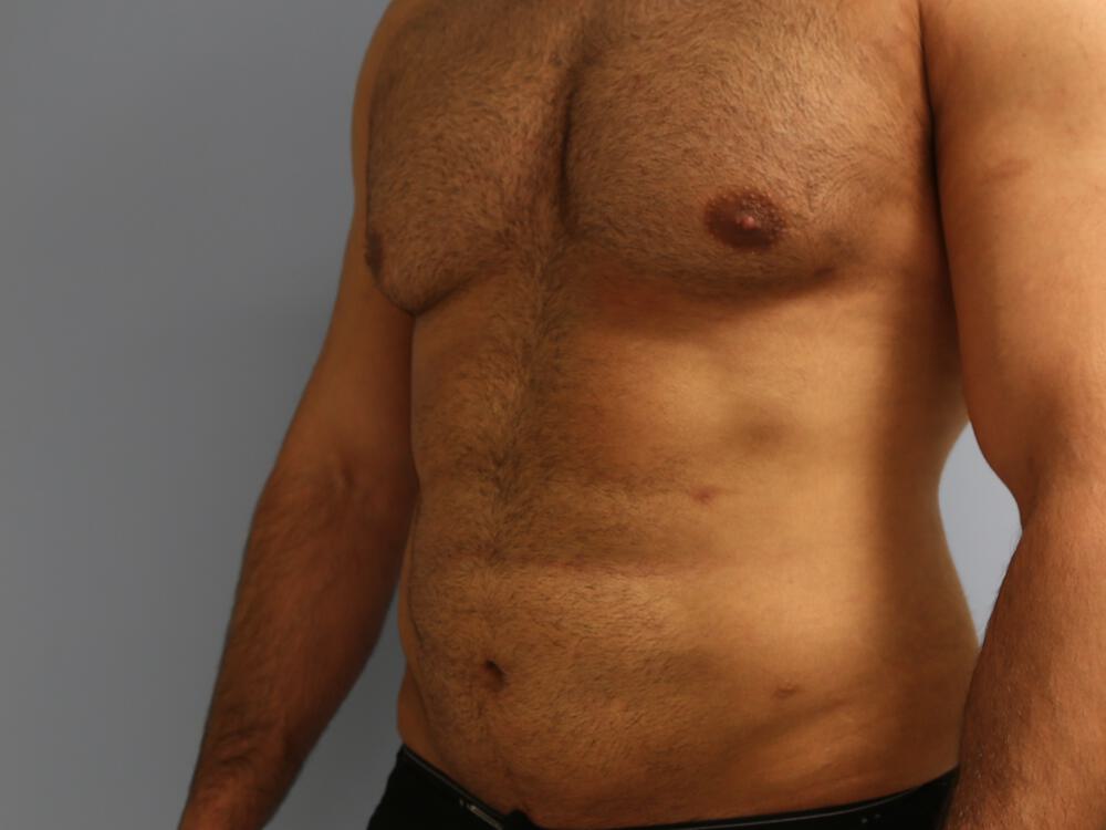 Ab Etching Before & After Image