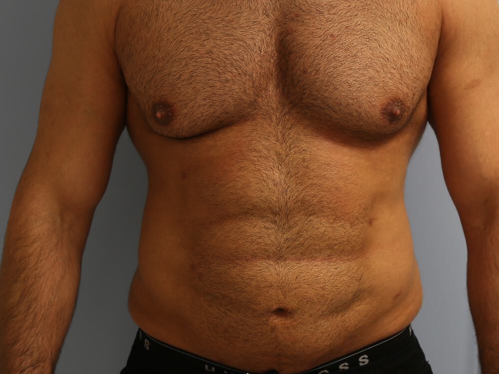 Ab Etching Before & After Image