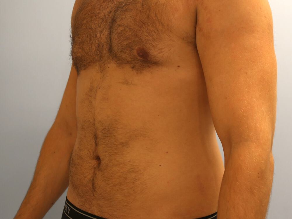 Ab Etching Before & After Image