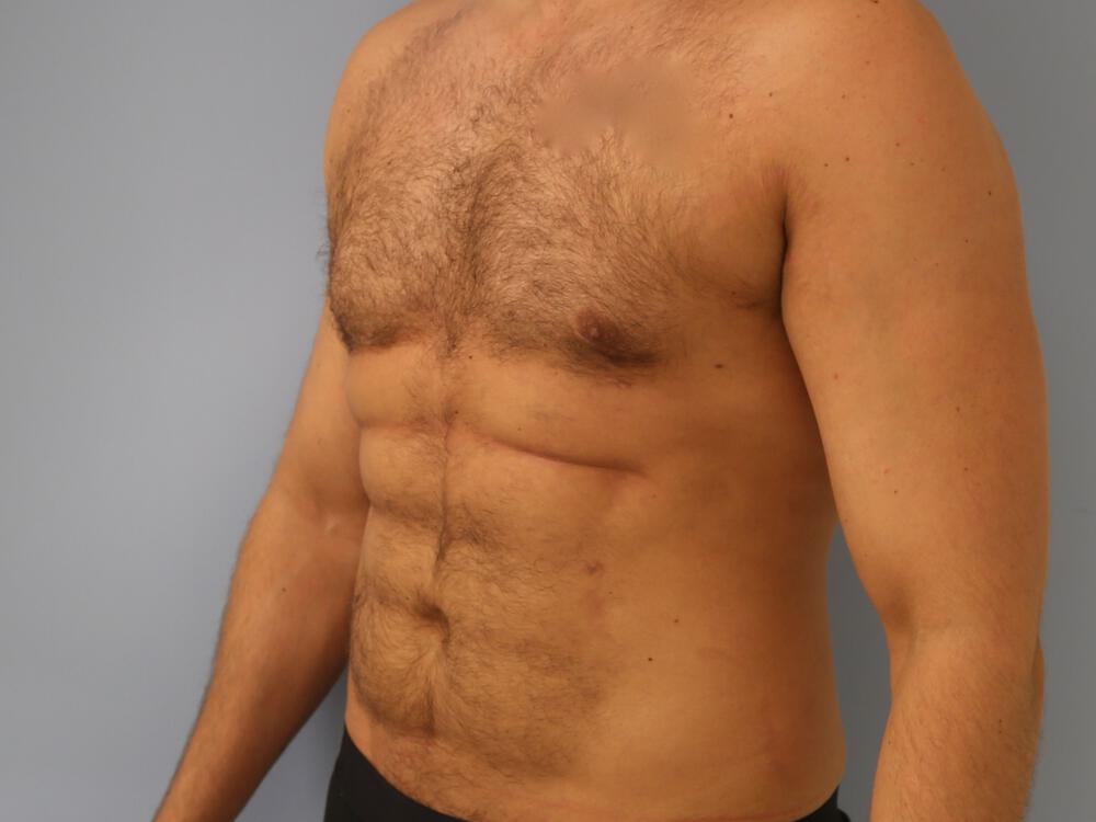 Ab Etching Before & After Image