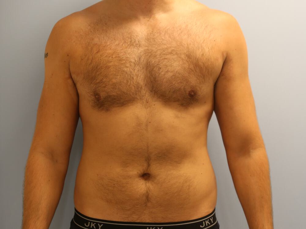 Ab Etching Before & After Image