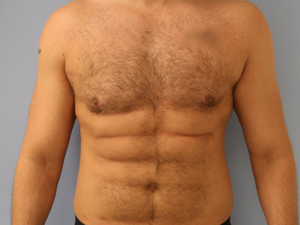 Ab Etching Before & After Image