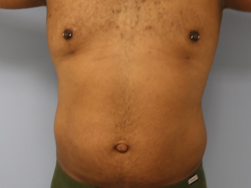 Ab Etching Before & After Image