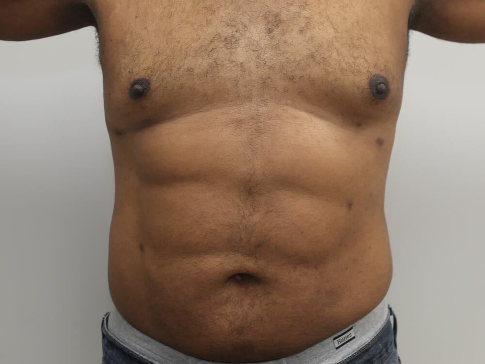 Ab Etching Before & After Image