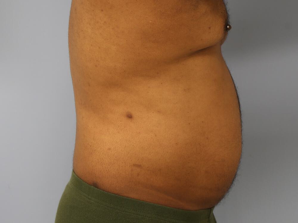 Ab Etching Before & After Image