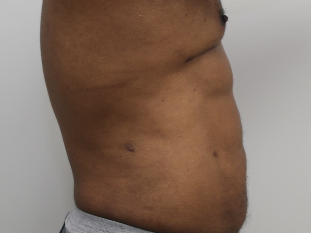 Ab Etching Before & After Image