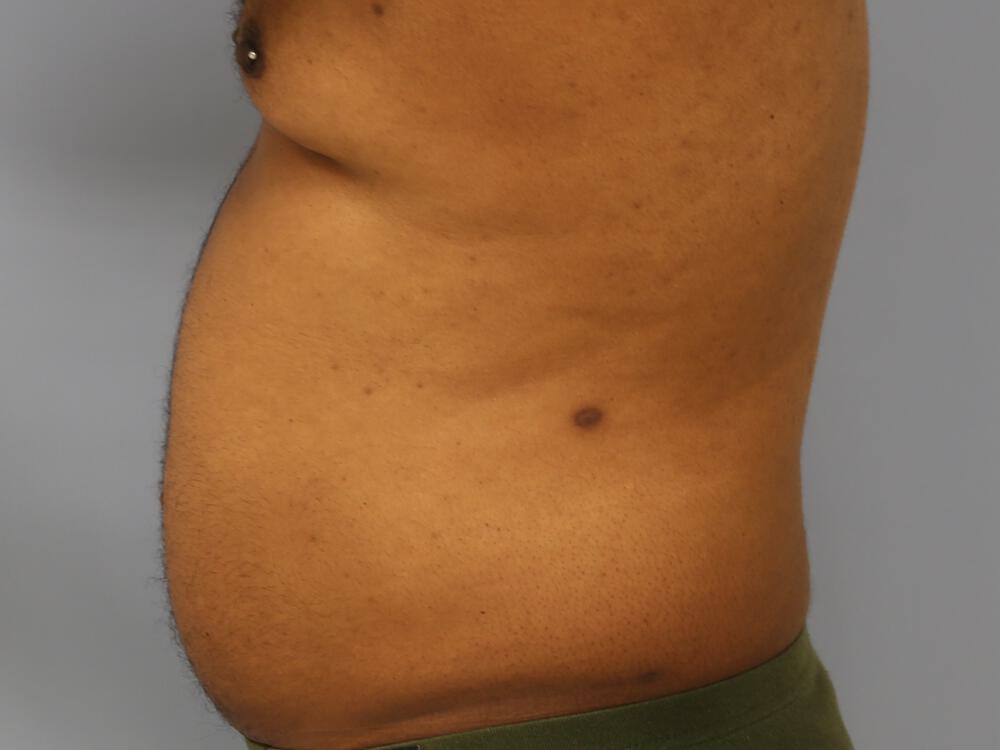 Ab Etching Before & After Image