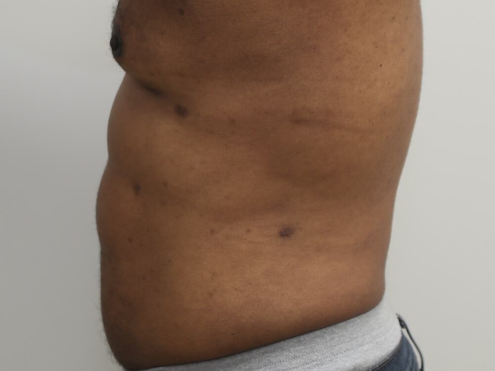 Ab Etching Before & After Image