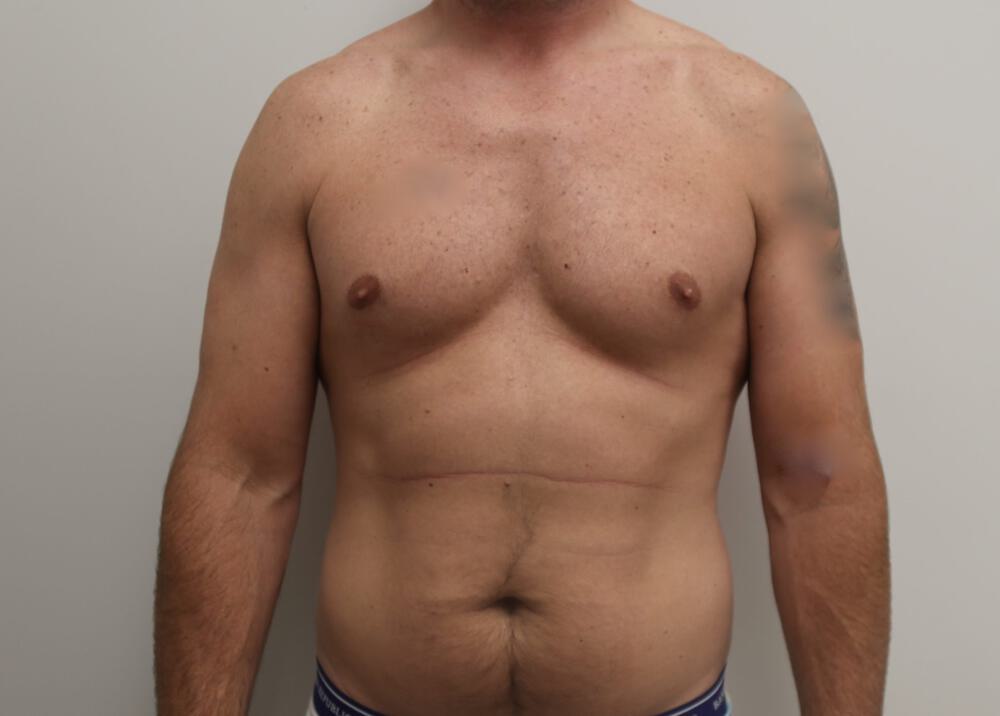 Ab Etching Before & After Image