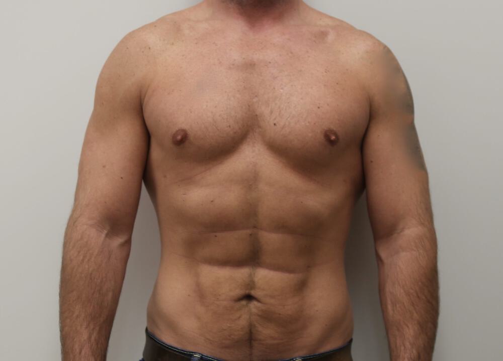 Ab Etching Before & After Image