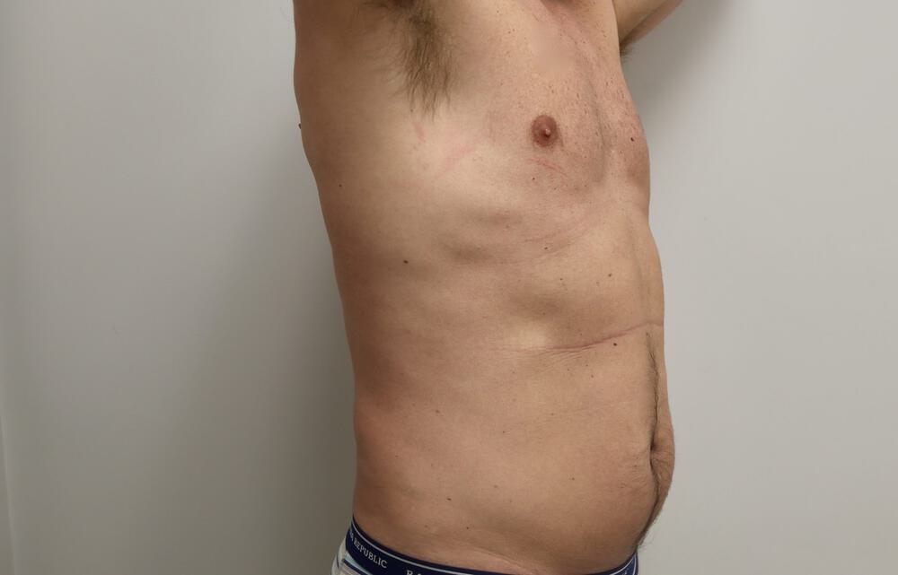 Ab Etching Before & After Image