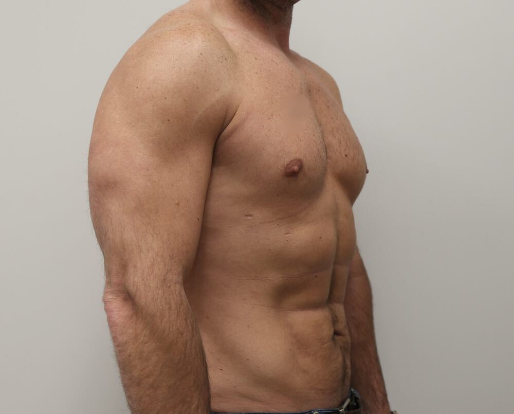 Ab Etching Before & After Image