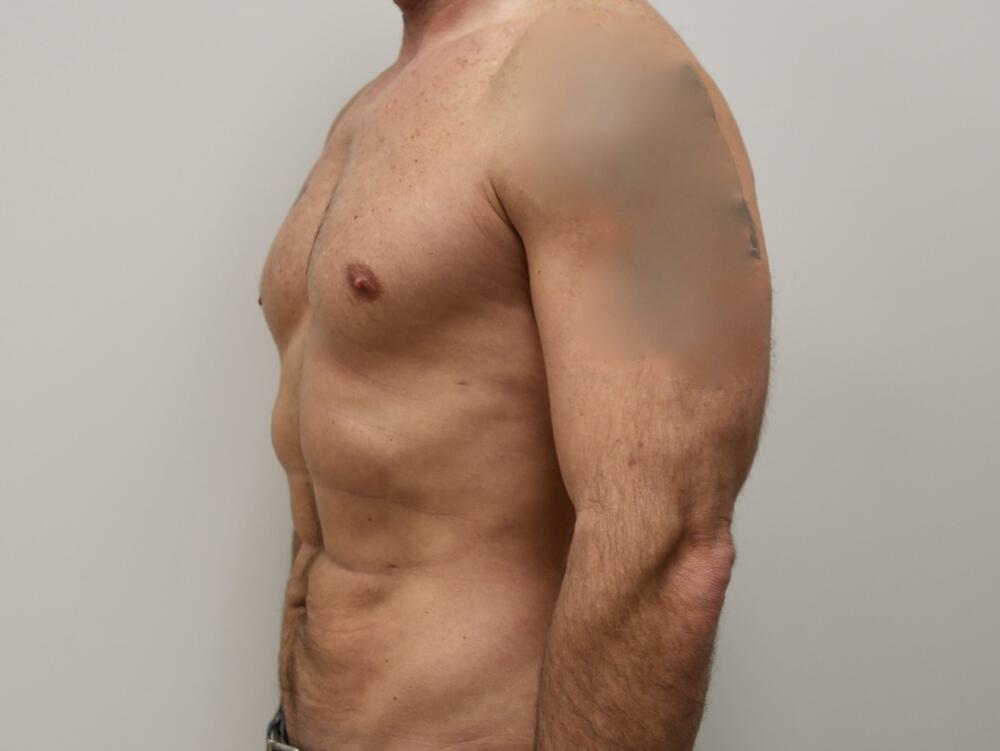 Ab Etching Before & After Image