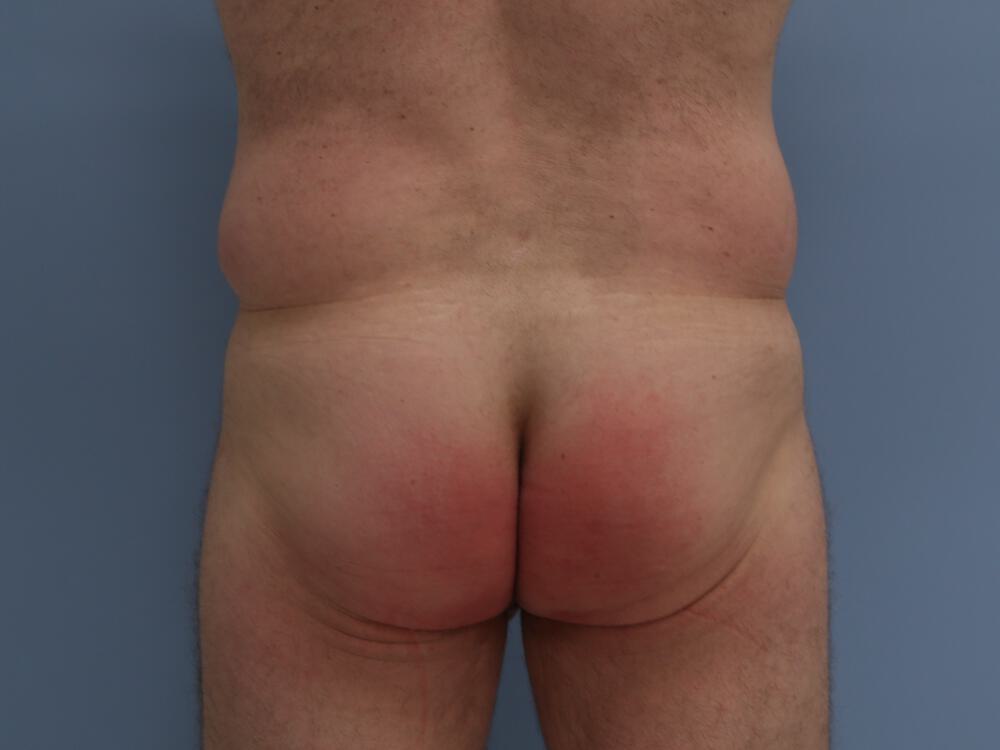 Male Butt Implants Before & After Image