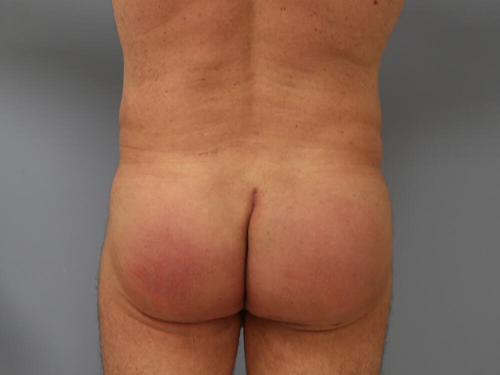 Male Butt Implants Before & After Image