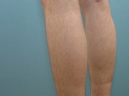 Male Calf Implants Before & After Image