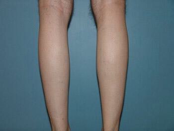 Male Calf Implants Before & After Image