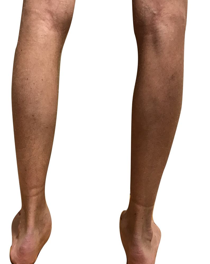 Male Calf Implants Before & After Image