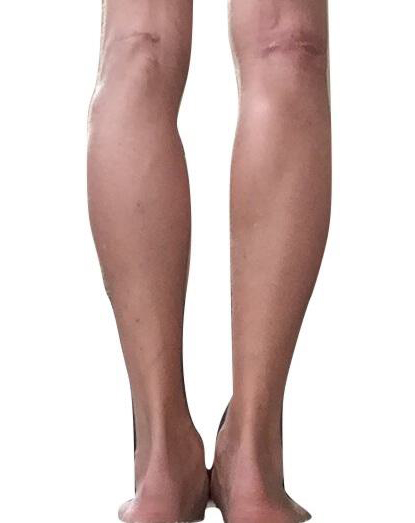 Male Calf Implants Before & After Image