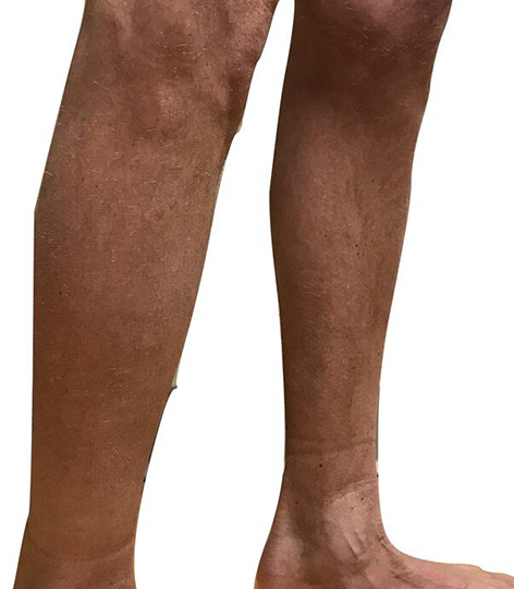 Male Calf Implants Before & After Image