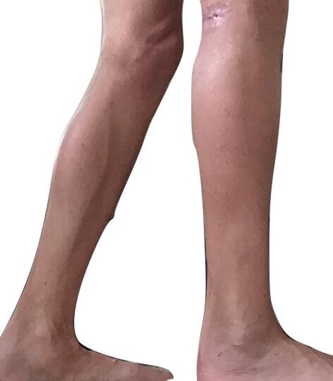 Male Calf Implants Before & After Image