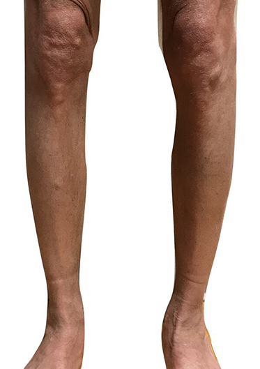 Male Calf Implants Before & After Image
