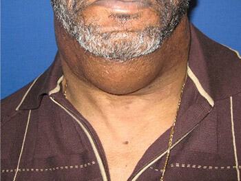 Male Facial Surgery Before & After Image