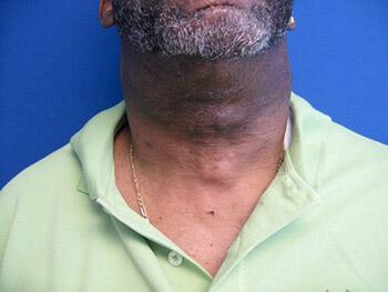 Male Facial Surgery Before & After Image