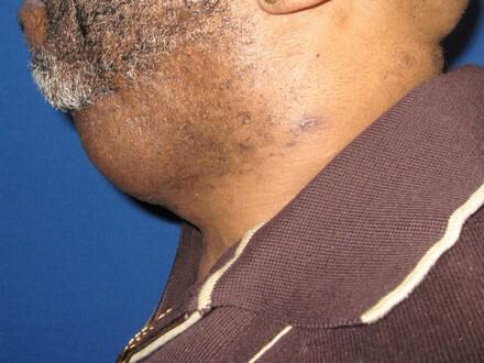 Male Facial Surgery Before & After Image