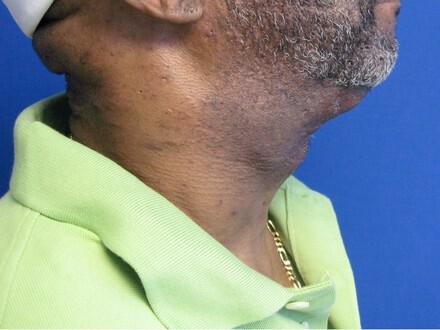 Male Facial Surgery Before & After Image