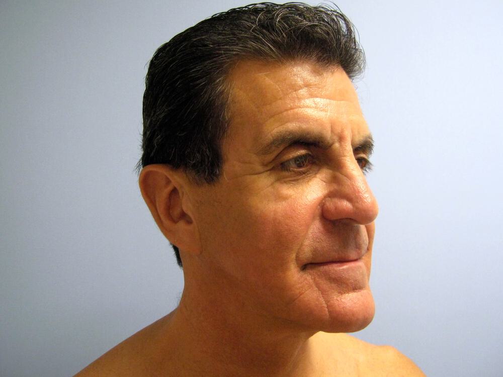 Male Facial Surgery Before & After Image