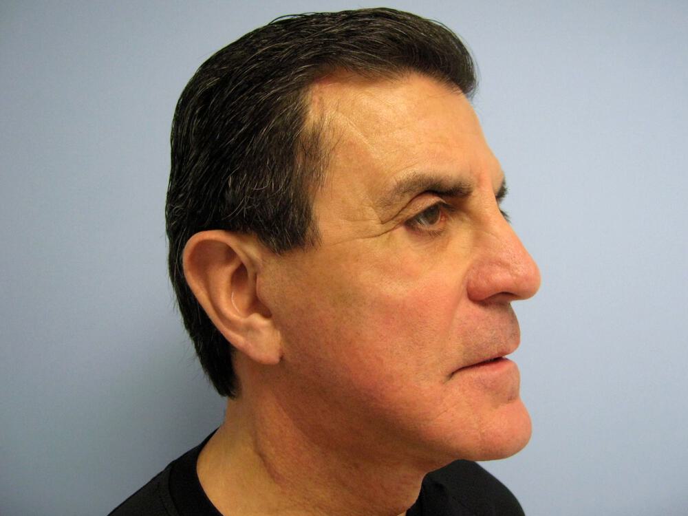 Male Facial Surgery Before & After Image
