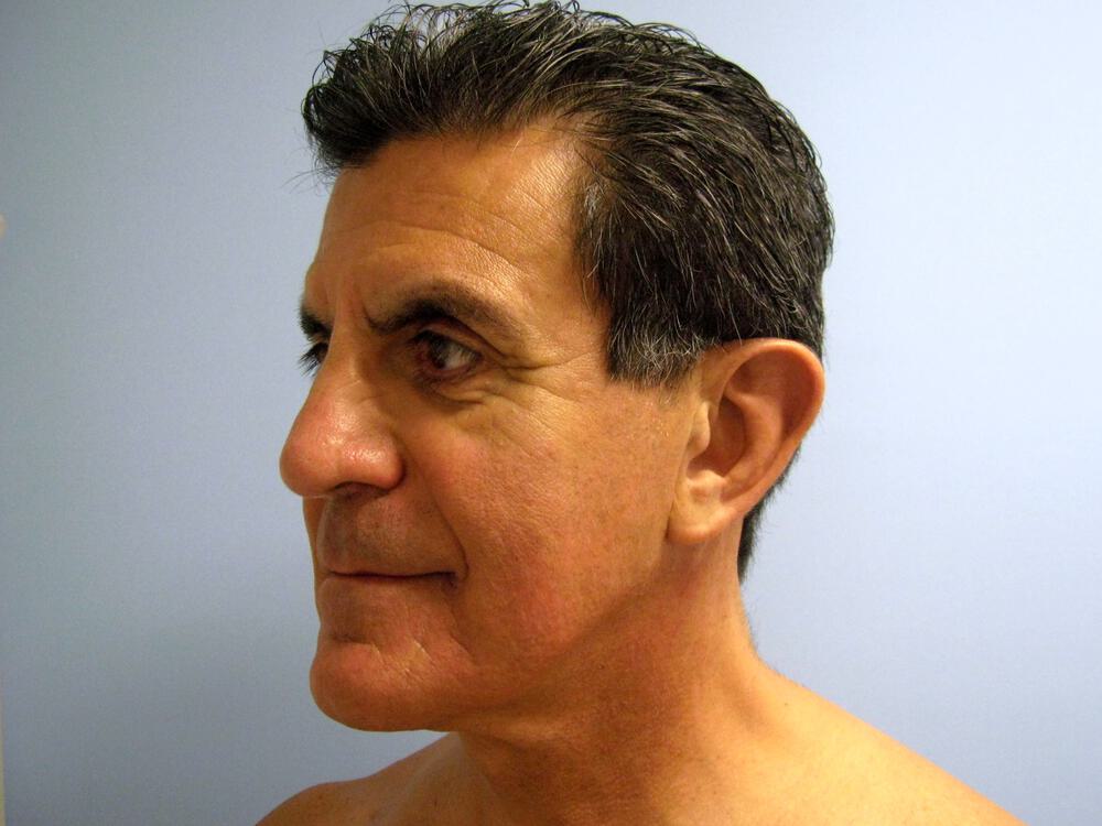 Male Facial Surgery Before & After Image