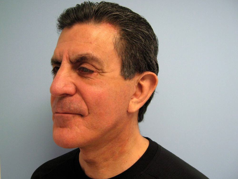 Male Facial Surgery Before & After Image