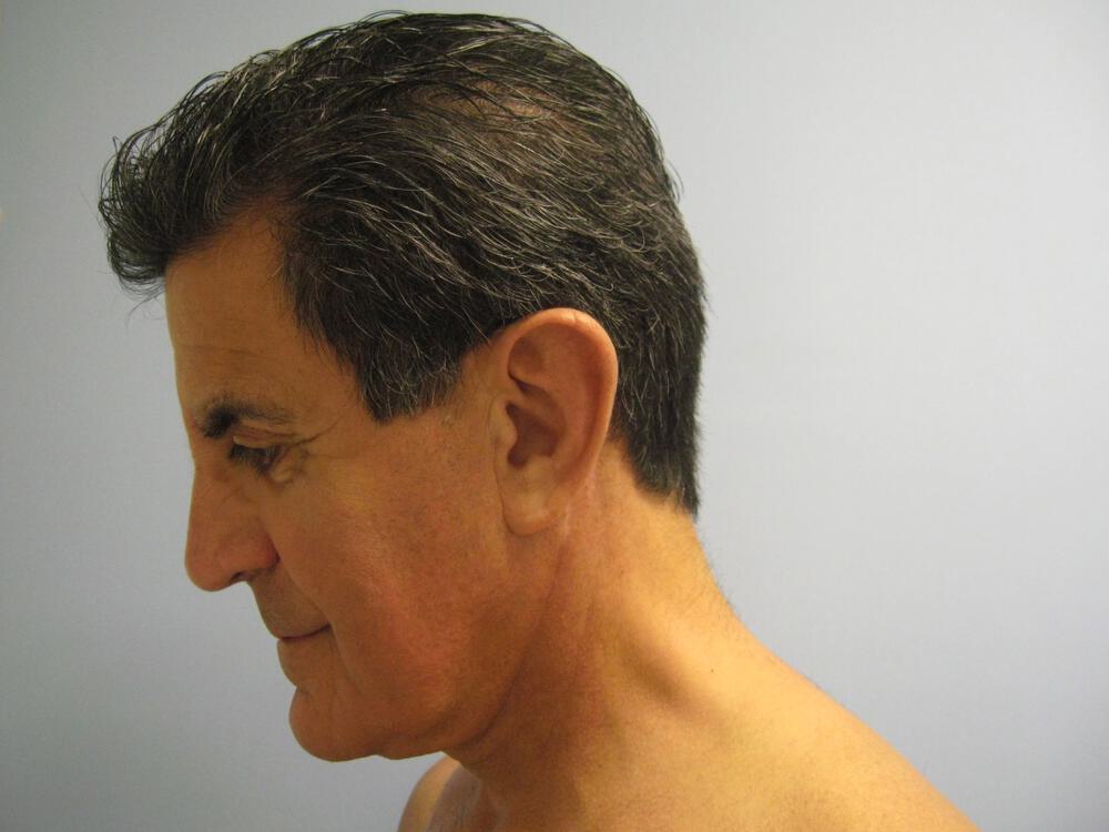 Male Facial Surgery Before & After Image
