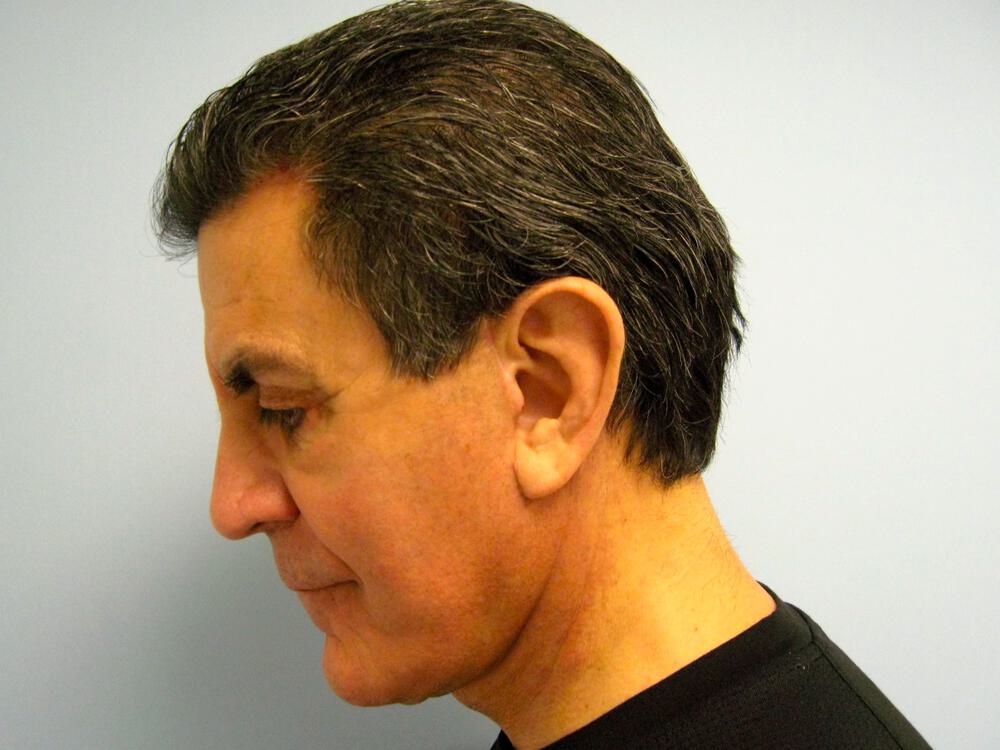 Male Facial Surgery Before & After Image