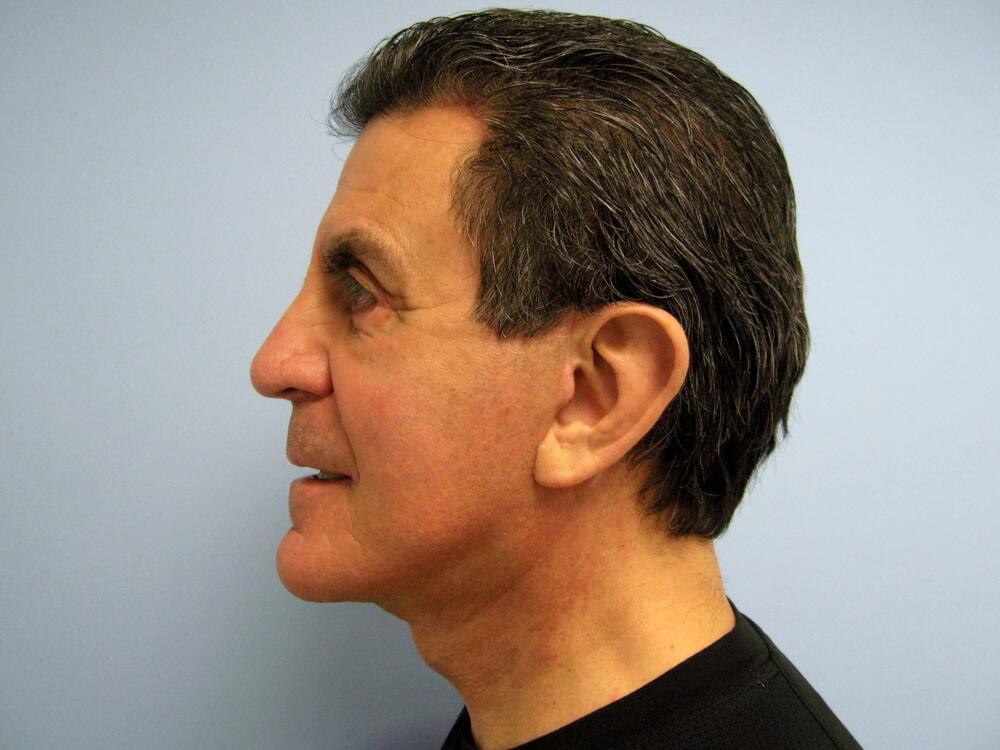 Male Facial Surgery Before & After Image