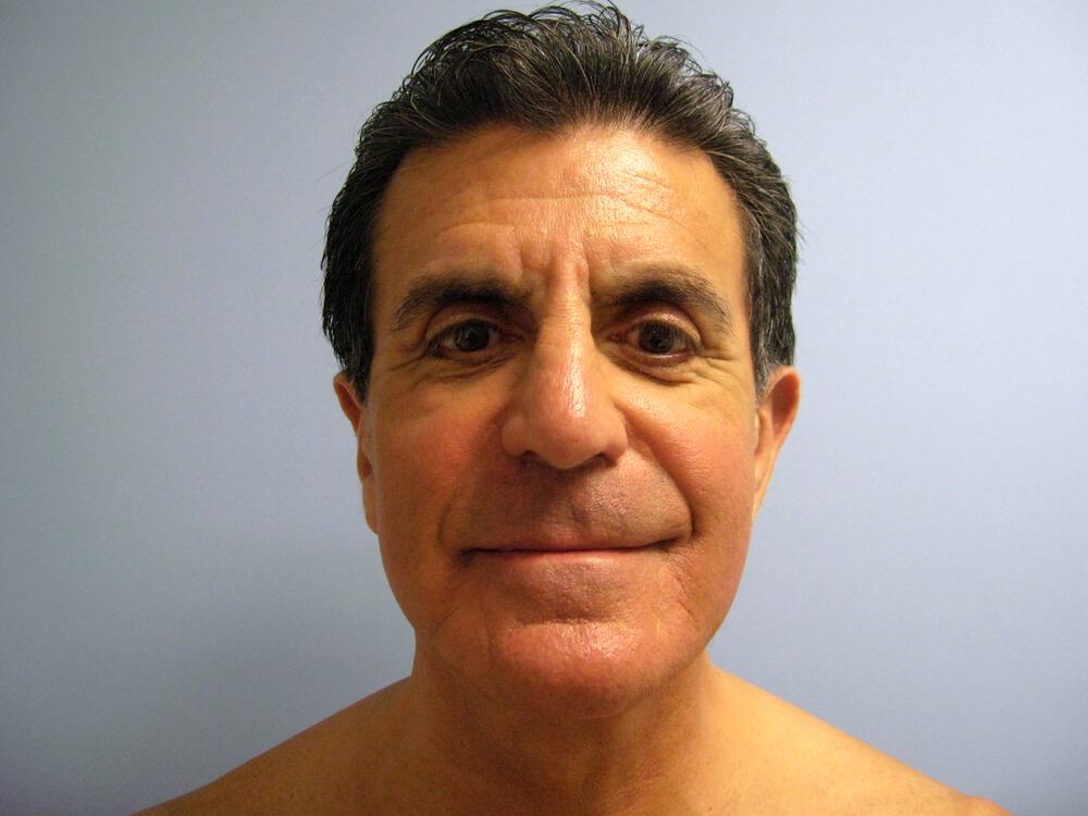 Male Facial Surgery Before & After Image