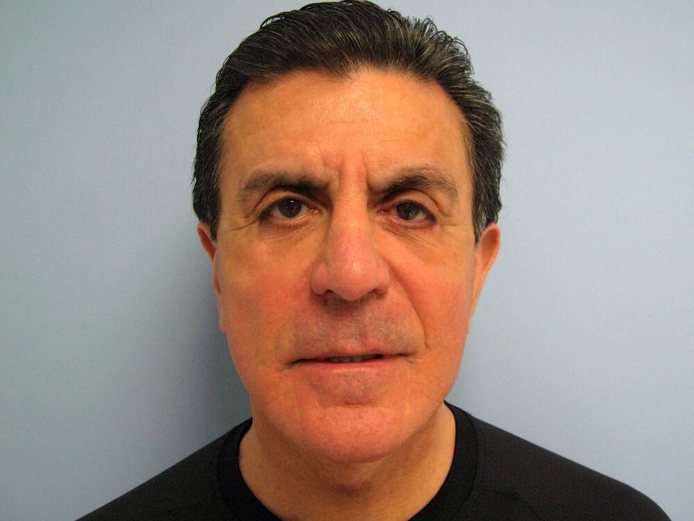 Male Facial Surgery Before & After Image