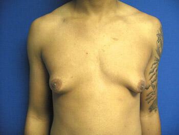 Gynecomastia Surgery Before & After Image