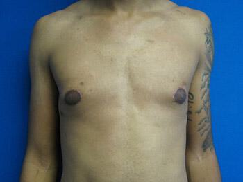 Gynecomastia Surgery Before & After Image