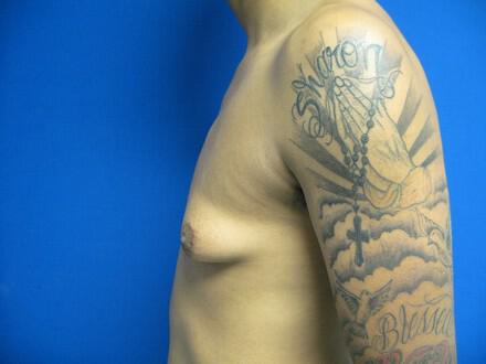 Gynecomastia Surgery Before & After Image