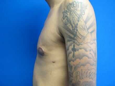 Gynecomastia Surgery Before & After Image