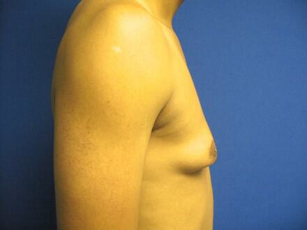 Gynecomastia Surgery Before & After Image