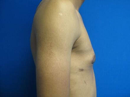 Gynecomastia Surgery Before & After Image