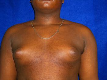 Gynecomastia Surgery Before & After Image