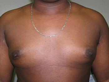 Gynecomastia Surgery Before & After Image