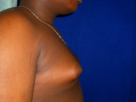 Gynecomastia Surgery Before & After Image