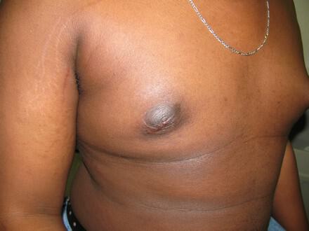Gynecomastia Surgery Before & After Image