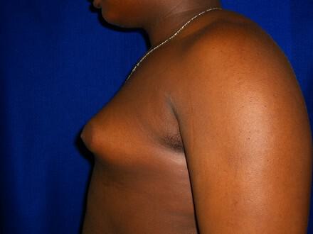 Gynecomastia Surgery Before & After Image